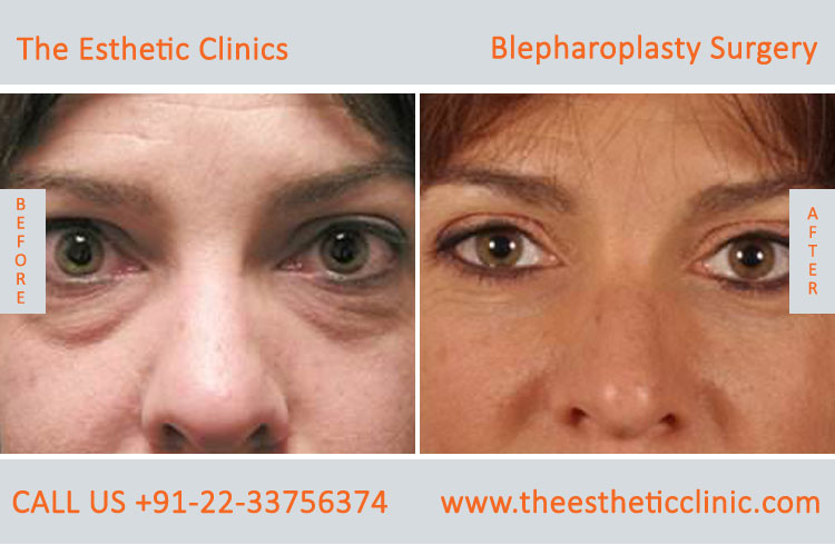 Blepharoplasty Surgery, Eyelid lift surgery before after photos in mumbai india (6)